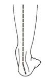 Pronation de l'arrière pied Pronation de l'arrière pied