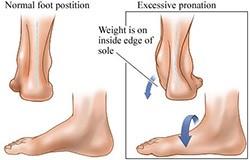 Pied plat valgus Pied plat valgus